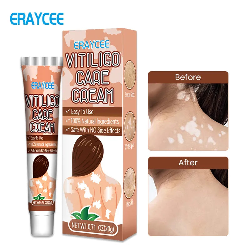 Crème anti-vitiligo à base de plantes très efficace.